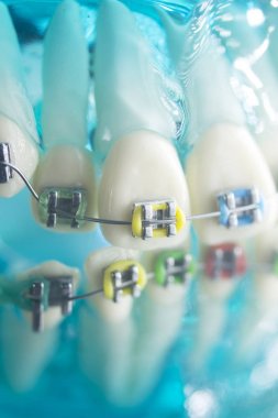 Diş diş köşeli metal