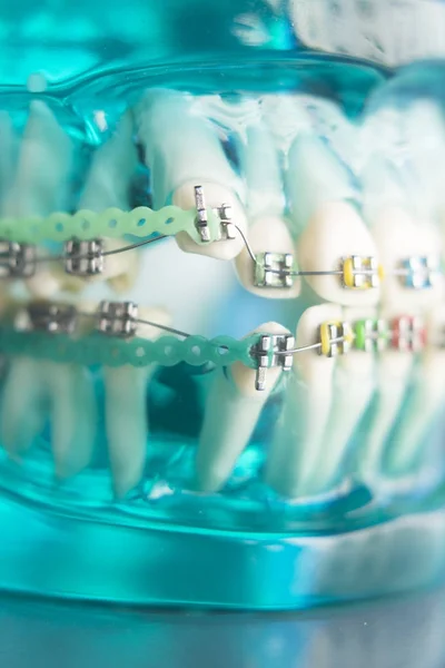 Zahnhalterungen aus Metall — Stockfoto
