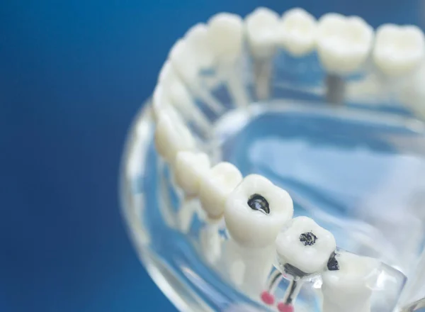Denti dentali modello bocca — Foto Stock