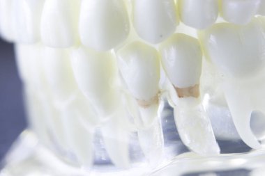 Dental plak diş çürüğü