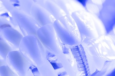 Diş titanyum implant diş