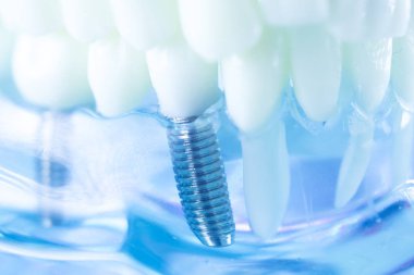 Diş titanyum implant diş