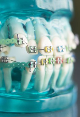 Diş diş köşeli metal