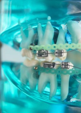 Diş diş köşeli metal