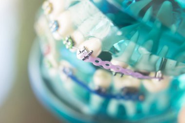 Diş diş köşeli metal