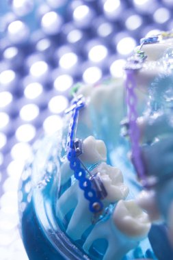 Diş diş köşeli metal