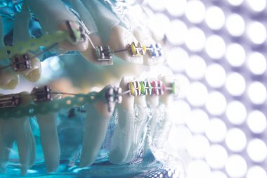 Diş diş köşeli metal