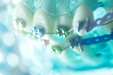 Diş diş köşeli metal