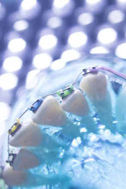 Diş diş köşeli metal