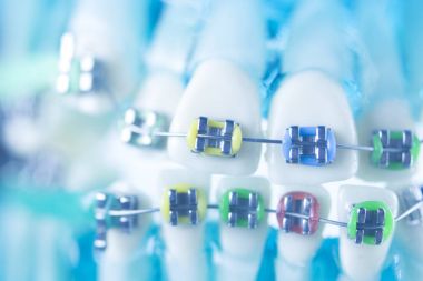 Diş diş köşeli metal