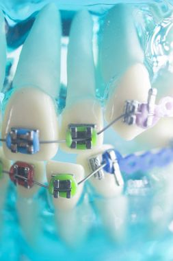 Diş diş köşeli metal