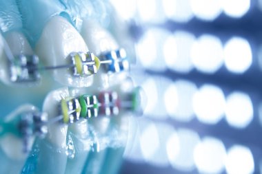 Diş diş köşeli metal