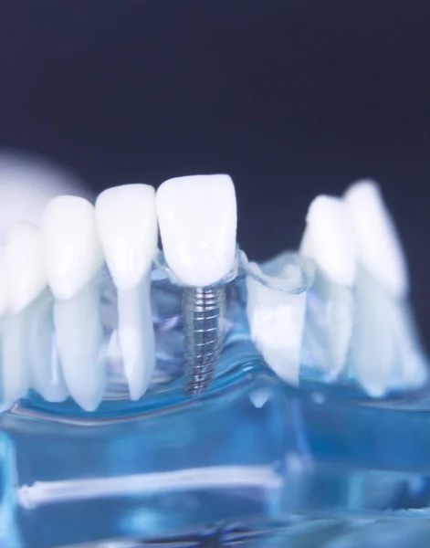 Dentstas modelo de dientes dentales — Foto de Stock