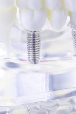 Diş titanyum implant diş