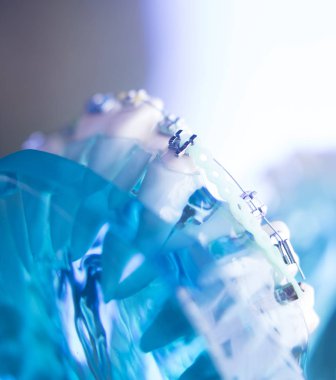 Diş diş köşeli metal