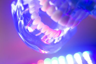 Ortodontik diş diş modeli