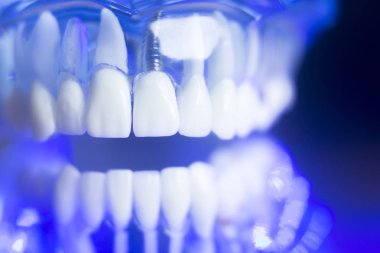 Diş hizalama diş modeli