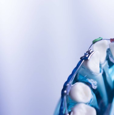 Diş diş köşeli metal