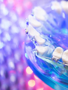 Diş diş köşeli metal