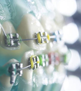 Diş diş köşeli metal