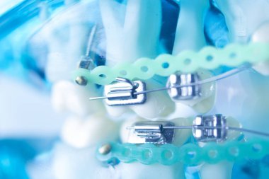 Diş diş köşeli metal