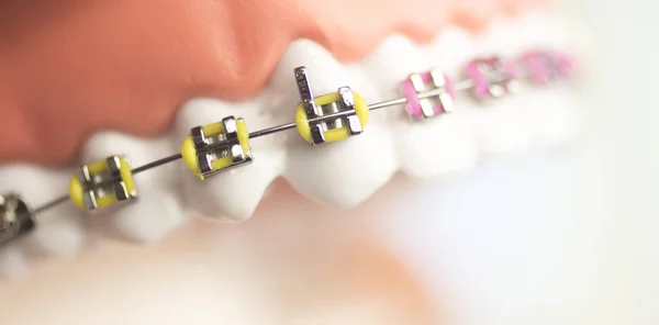 Suportes de metal dental cosmético — Fotografia de Stock