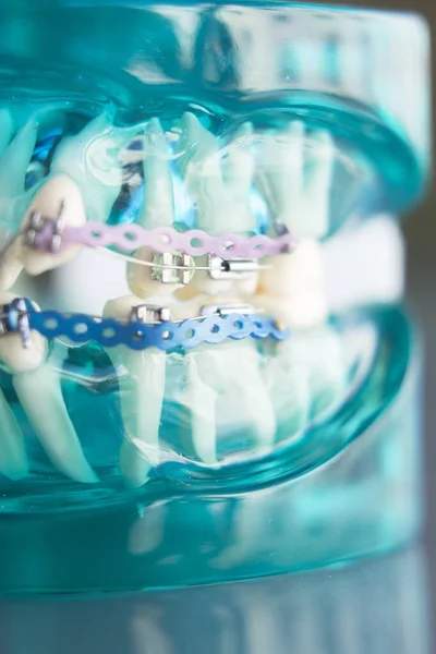 Tandheelkundige tanden metalen haken — Stockfoto