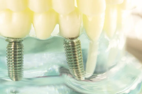 Impianto dentale in titanio — Foto Stock