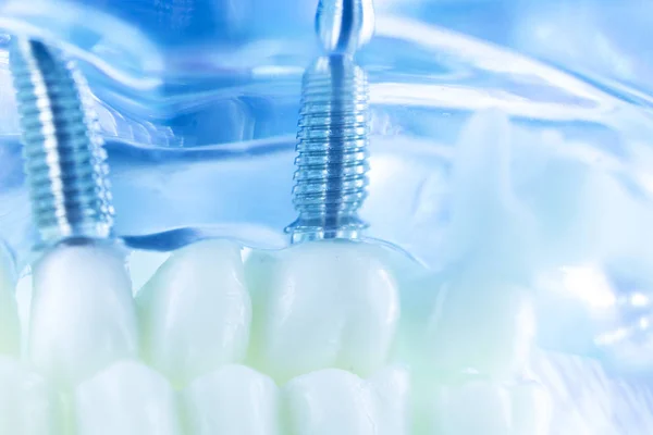 Implante dental de titanio — Foto de Stock