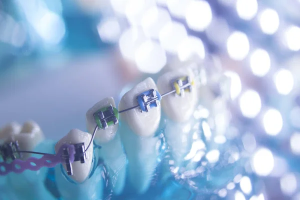 Dientes dentales soportes metálicos — Foto de Stock