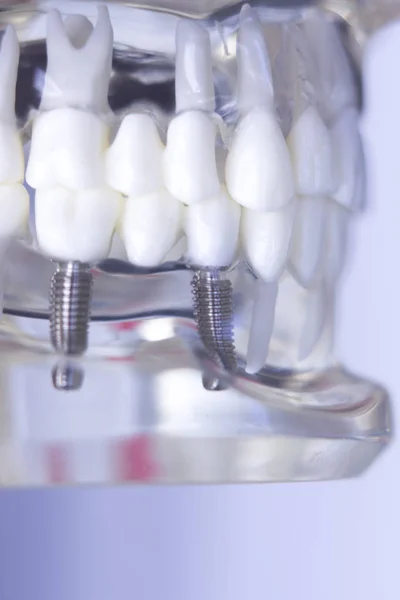 Dentsts dentystyczny ząb implantu — Zdjęcie stockowe