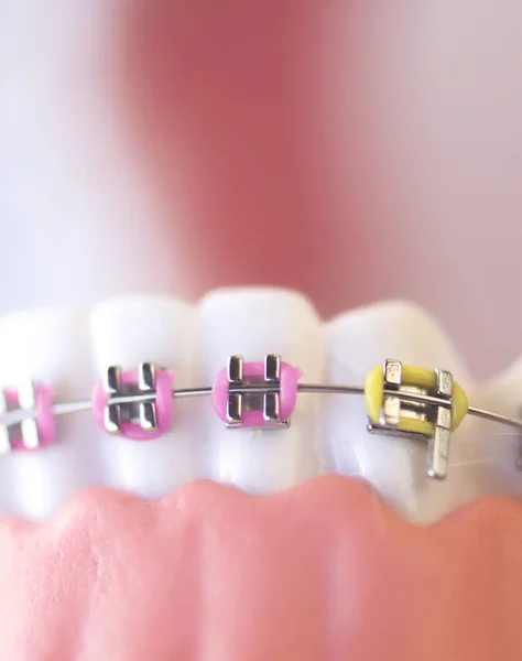 Cosmetic dental metal brackets — Stock Photo, Image