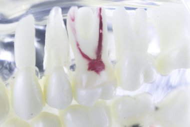 Diş diş kök kanal