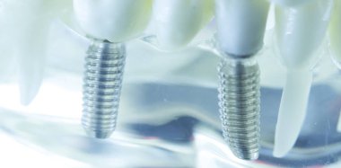 Diş titanyum implant diş