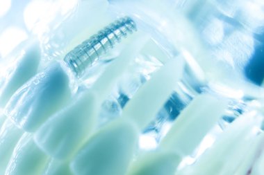 Diş titanyum implant diş