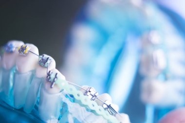 Diş diş köşeli metal