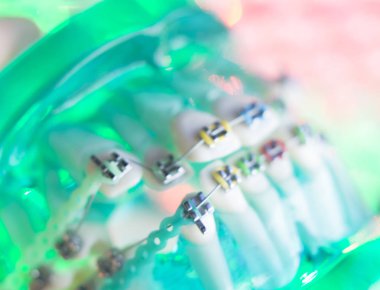 Diş diş köşeli metal