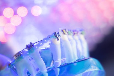 Diş diş köşeli metal