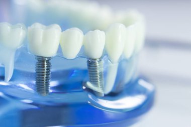 Diş diş dişçi modeli