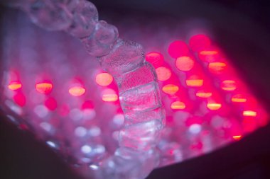 Görünmez diş aligners parantez