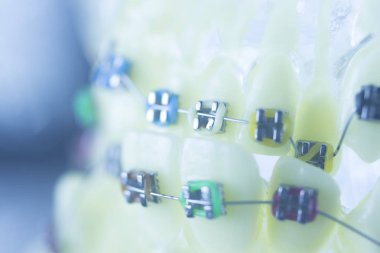 Diş diş parantez aligners