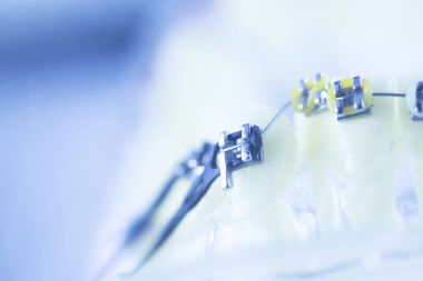 Diş diş parantez aligners