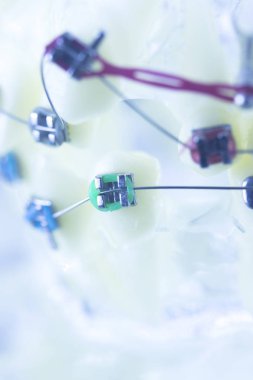 Diş diş parantez aligners