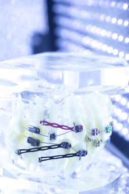 Diş diş parantez aligners