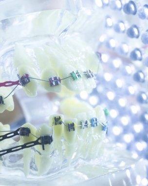 Diş diş parantez aligners