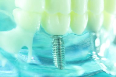 Diş titanyum implant diş