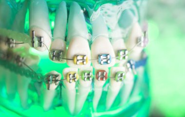 Diş diş köşeli metal