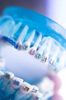 Diş diş köşeli metal