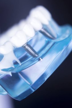 Dentsts diş implant diş