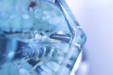 Dentsts diş implant diş